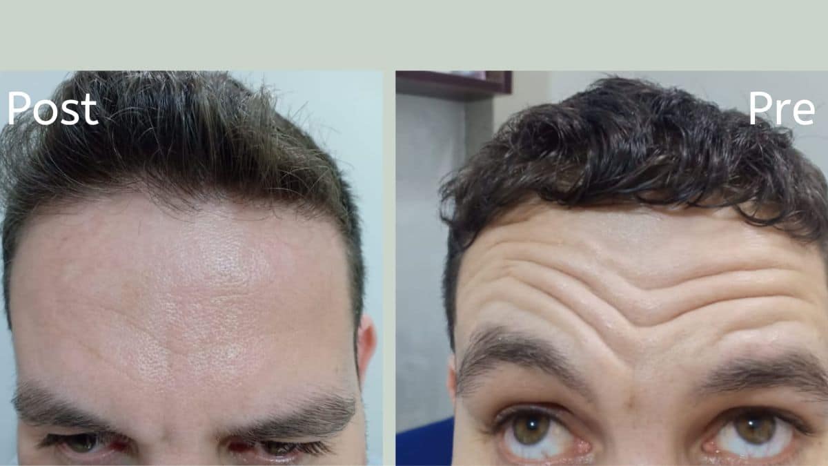 حقن البوتوكس في الغردقة